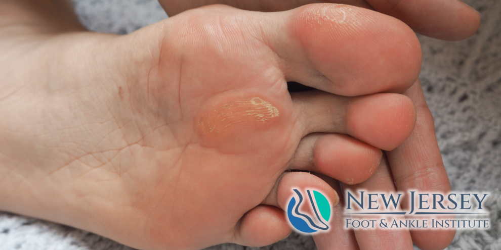 Corns vs. Calluses What’s the Difference