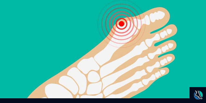 bunion-arthritis-min What is Bunion Arthritis - ftd img