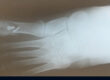 My Foot Surgery by Dr. Stephen Guiliana - Roxbury Foot and Ankle Center