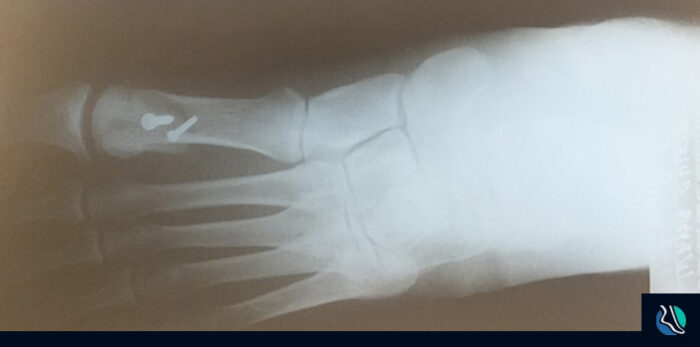 My Foot Surgery by Dr. Stephen Guiliana - Roxbury Foot and Ankle Center