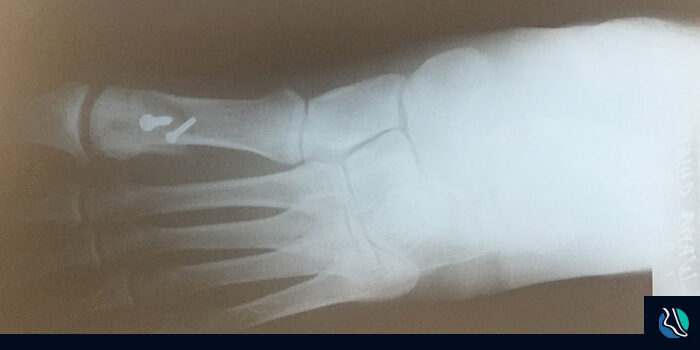 chieppa-xray-surgery-foot-min My Foot Surgery by Dr. Stephen Guiliana - Roxbury Foot and Ankle Center