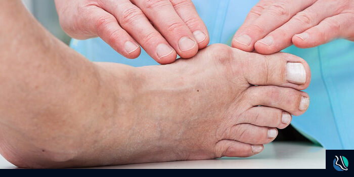 hallux-rigidus-min Hallux Rigidus - Toe Stiffness and Pain