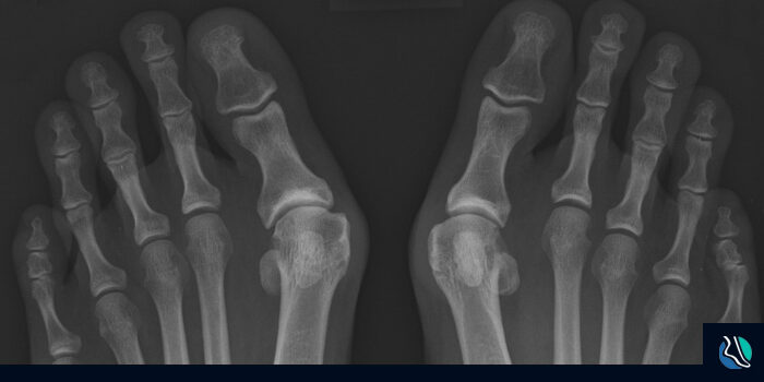 what-is-a-bunion What is a bunion?