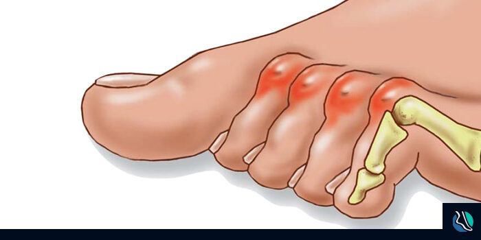 what-is-hammertoe-ftd-min The best explanation of Hammertoe