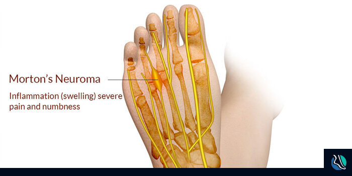 what-is-neuroma What Is Neuroma?