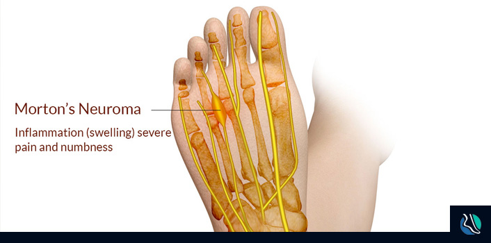 what-is-neuroma What Is Neuroma?